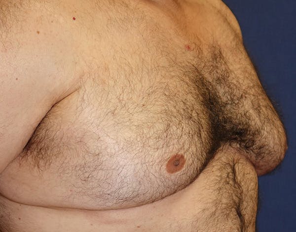 Male Subcutaneous Mastectomy (Gynecomastia) Gallery - Patient 148829205 - Image 3