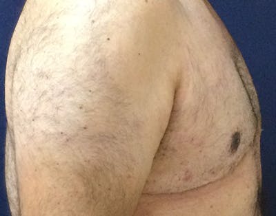 Male Subcutaneous Mastectomy (Gynecomastia) Gallery - Patient 148829205 - Image 6