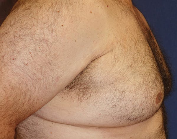 Male Subcutaneous Mastectomy (Gynecomastia) Gallery - Patient 148829205 - Image 5