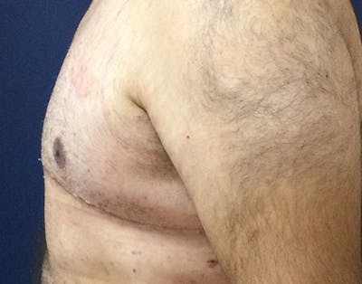 Male Subcutaneous Mastectomy (Gynecomastia) Gallery - Patient 148829205 - Image 10