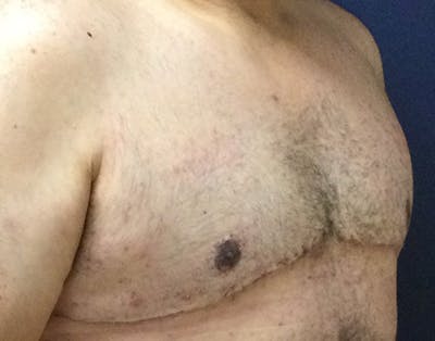 Male Subcutaneous Mastectomy (Gynecomastia) Gallery - Patient 148829205 - Image 4