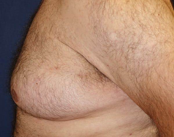 Male Subcutaneous Mastectomy (Gynecomastia) Gallery - Patient 148829205 - Image 9