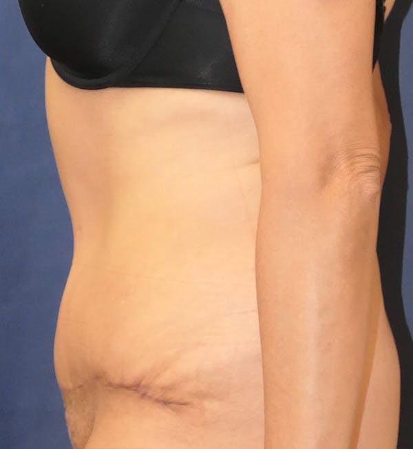 Tummy Tuck (Abdominoplasty) Gallery - Patient 148829203 - Image 6