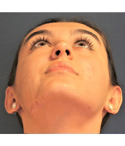 Ear Pinning (Otoplasty) Gallery - Patient 347035 - Image 6