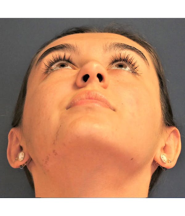 Ear Pinning (Otoplasty) Gallery - Patient 347035 - Image 6