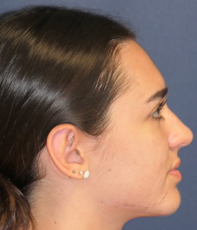 Ear Pinning (Otoplasty) Gallery - Patient 347035 - Image 4