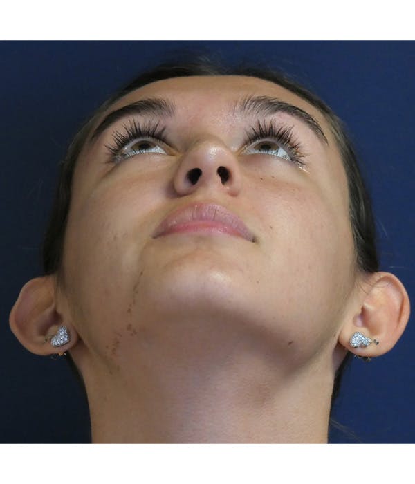 Ear Pinning (Otoplasty) Gallery - Patient 347035 - Image 5