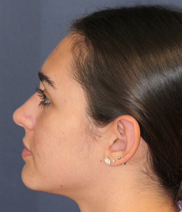 Ear Pinning (Otoplasty) Gallery - Patient 347035 - Image 10