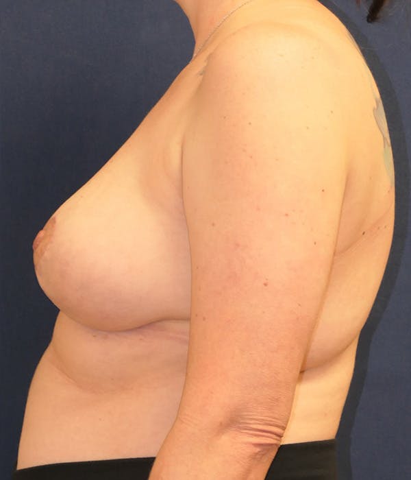 Breast Lift Gallery - Patient 170394 - Image 10