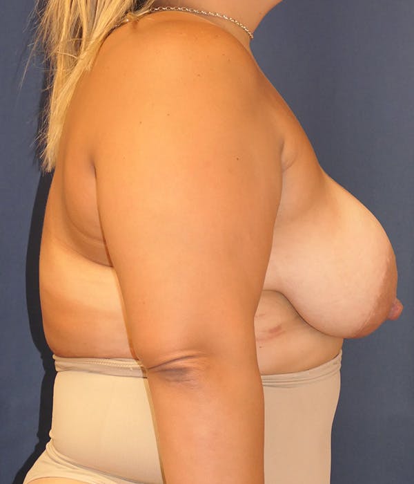 Breast Lift Gallery - Patient 138965 - Image 5