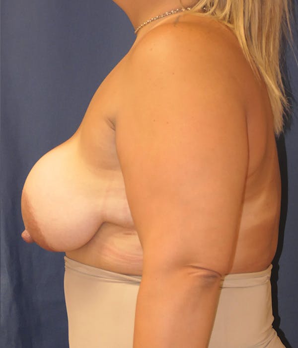 Breast Augmentation Gallery - Patient 162302 - Image 9