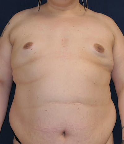 Breast Augmentation Gallery - Patient 206871 - Image 1