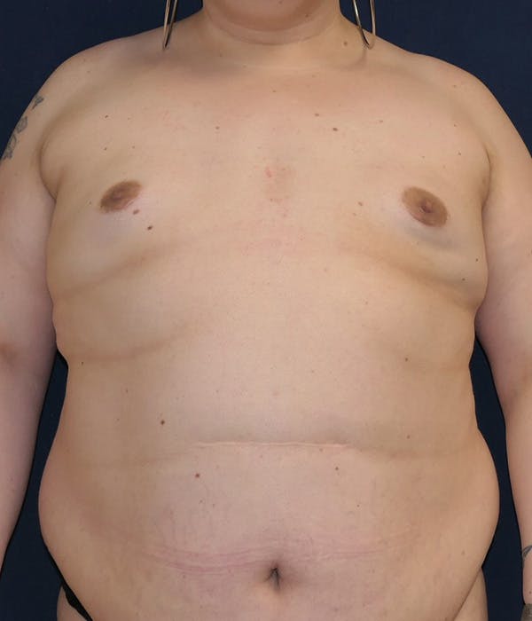 Breast Augmentation Gallery - Patient 206871 - Image 1