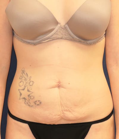 Tummy Tuck (Abdominoplasty) Gallery - Patient 389692 - Image 1