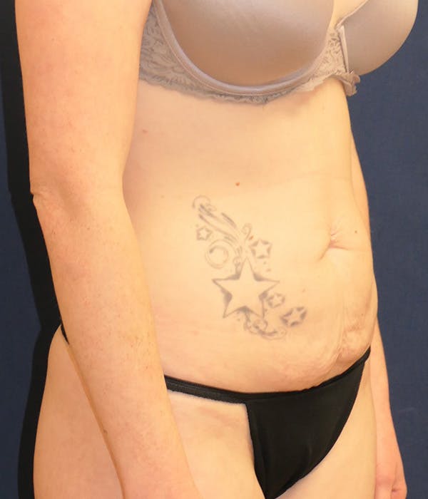 Tummy Tuck (Abdominoplasty) Gallery - Patient 389692 - Image 3