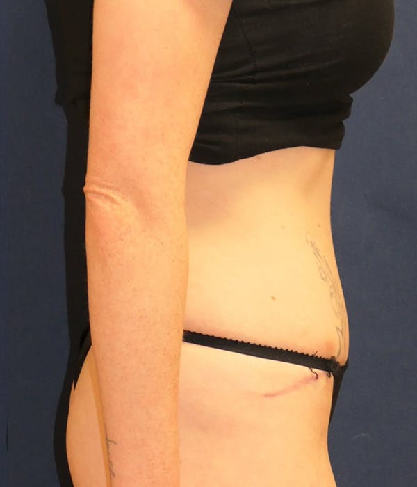 Tummy Tuck (Abdominoplasty) Gallery - Patient 389692 - Image 6