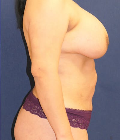 Breast Augmentation Gallery - Patient 294266 - Image 6