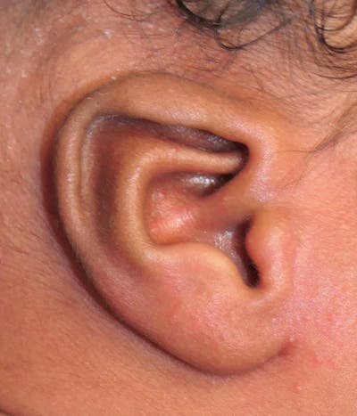 Ear Molding Gallery - Patient 940199 - Image 1