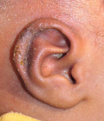 Ear Molding Gallery - Patient 940199 - Image 2