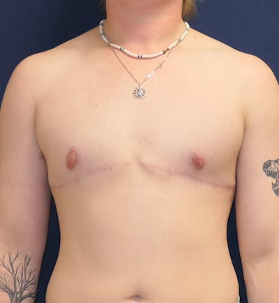 Masculinizing Surgery Gallery - Patient 371882 - Image 2