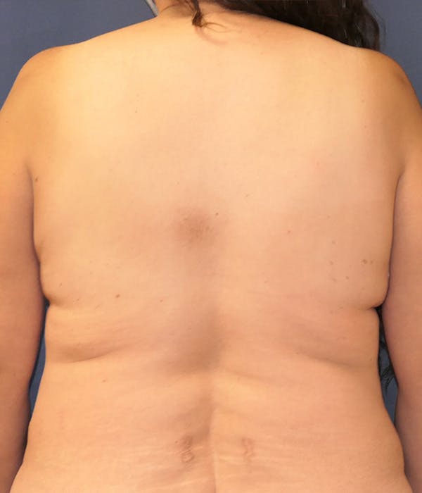 Breast Reconstruction Gallery - Patient 259946 - Image 11