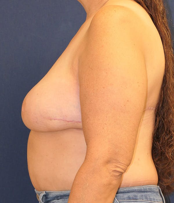 Breast Reconstruction Gallery - Patient 259946 - Image 10