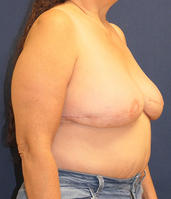 Breast Reconstruction Gallery - Patient 259946 - Image 4