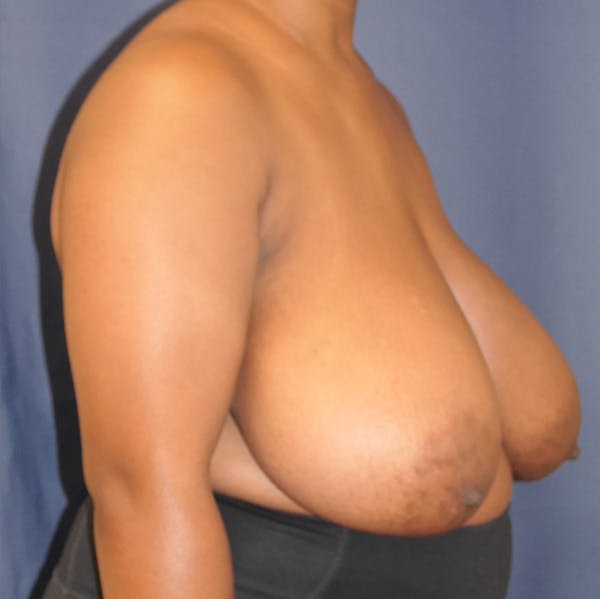 Breast Reduction Gallery - Patient 527239 - Image 3