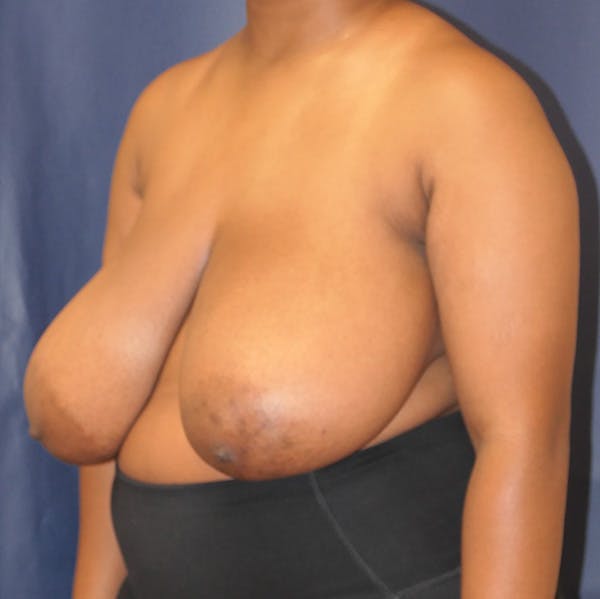 Breast Reduction Gallery - Patient 527239 - Image 7