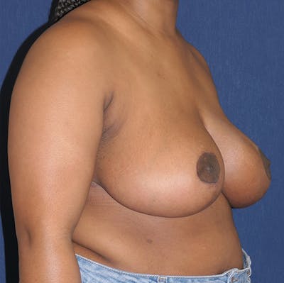Breast Reduction Gallery - Patient 527239 - Image 4