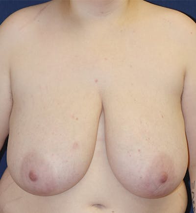 Masculinizing Surgery Gallery - Patient 260583 - Image 1