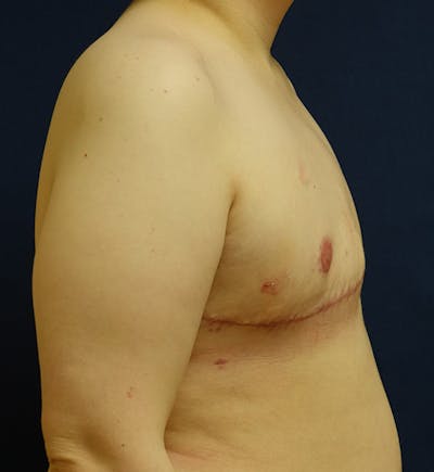 Masculinizing Surgery Gallery - Patient 260583 - Image 4