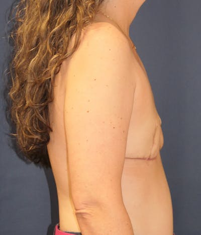 Breast Reconstruction Gallery - Patient 331785 - Image 6