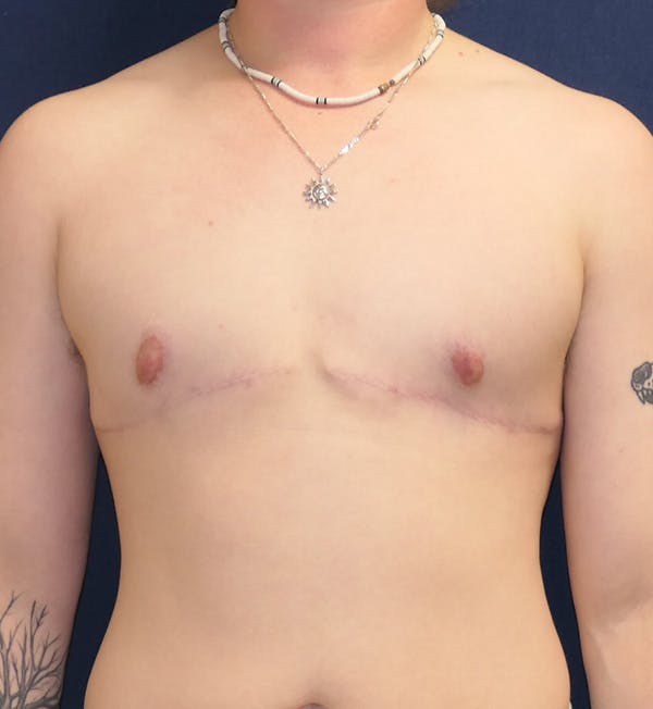 Masculinizing Surgery Gallery - Patient 371882 - Image 2