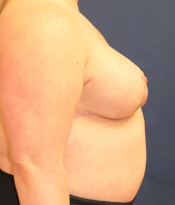 Breast Reconstruction Gallery - Patient 254410 - Image 8