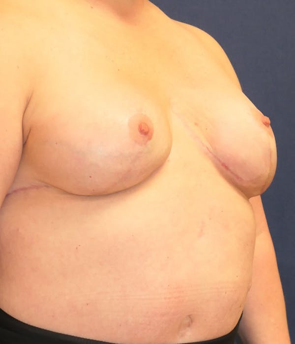 Breast Reconstruction Gallery - Patient 254410 - Image 10