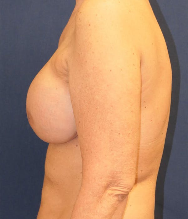 Breast Reconstruction Gallery - Patient 431419 - Image 6