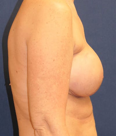 Breast Reconstruction Gallery - Patient 431419 - Image 8