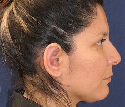 Ear Pinning (Otoplasty) Gallery - Patient 241064 - Image 4