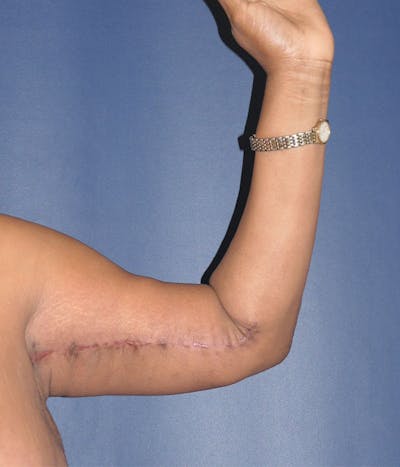 Arm Lift (Brachioplasty) Gallery - Patient 907555 - Image 6