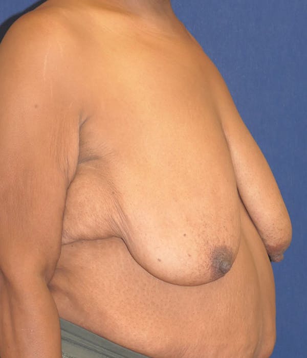 Breast Lift Gallery - Patient 427281 - Image 5
