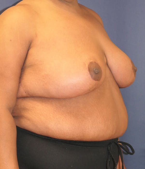 Breast Lift Gallery - Patient 770597 - Image 6