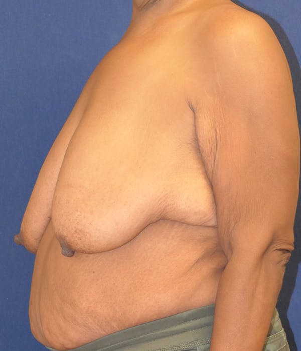 Breast Augmentation Gallery - Patient 114139 - Image 7