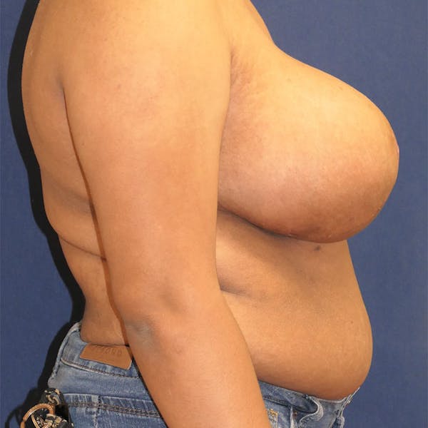 Breast Reduction Gallery - Patient 241660 - Image 4
