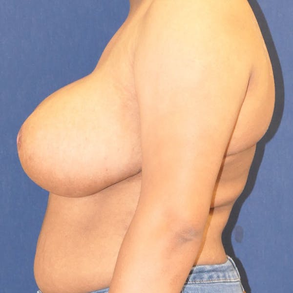 Breast Reduction Gallery - Patient 241660 - Image 10
