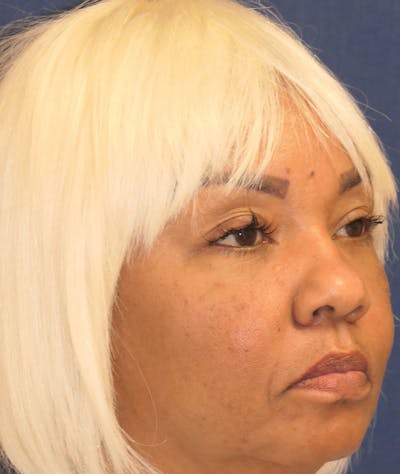 Eyelid Lift (Blepharoplasty) Gallery - Patient 377524 - Image 4