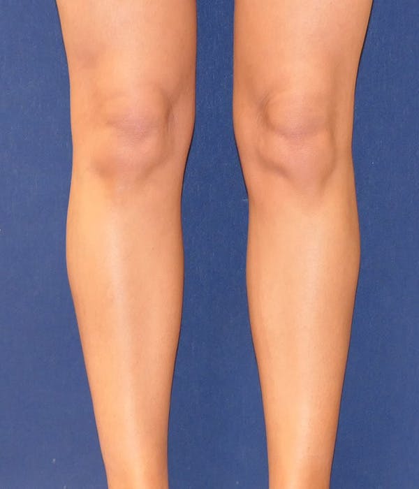 Calf Augmentation with Implants Gallery - Patient 277040 - Image 13