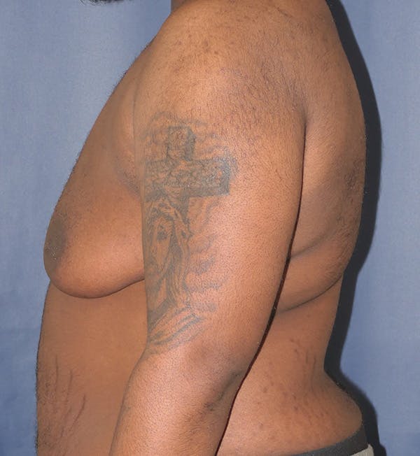 Masculinizing Surgery Gallery - Patient 410792 - Image 5