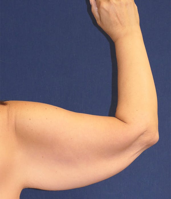 Arm Lift (Brachioplasty) Gallery - Patient 504481 - Image 1