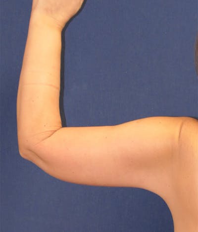 Arm Lift (Brachioplasty) Gallery - Patient 504481 - Image 6